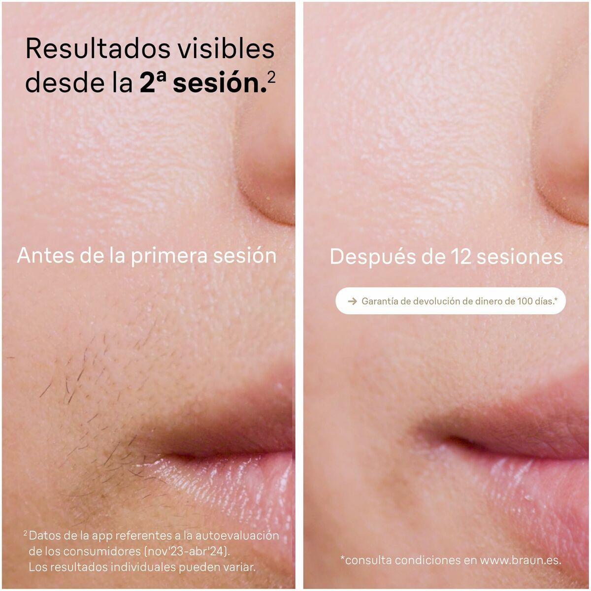 Ηλεκτρική Συσκευή Αφαίρεσης Μαλλιών Braun PL5382